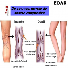 Sosete Terapeutice EDAR Cu Fermoar Lateral, Pentru Picioare Obosite, Stimularea Circulatiei Venoase, Bej, Marimea L/XL Sosete Terapeutice EDAR Cu Fermoar Lateral, Pentru Picioare Obosite, Stimularea Circulatiei Venoase, Bej, Marimea L/XL